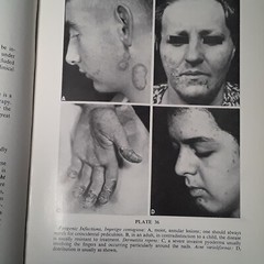 Practical Dermatology by George M. Lewis M.D. (Hardcover 1955)