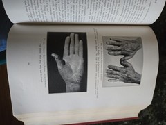 The Practitioners Library of Medicine and Surgery 1936 Dermatology & Syphilology