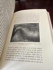 1990 The Classics of Surgery Library- DUODENAL ULCER By B. G. A . Moynihan