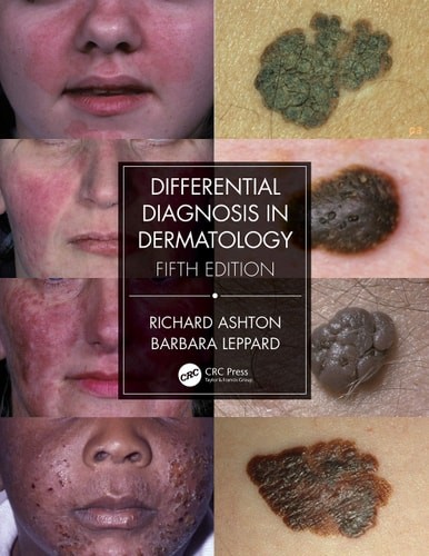 Differential Diagnosis in Dermatology – Ashton, Richard,Leppard, Barbara